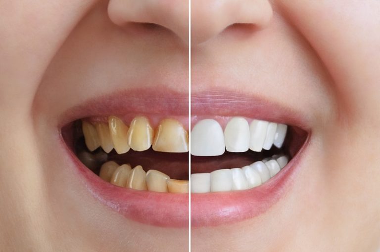 Cosmetic Dentistry in Olathe, KS A Reason To Smile