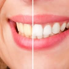 olathe dental care before and after tooth bleaching
