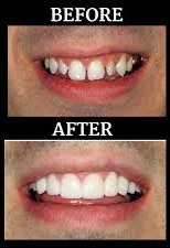 ODCC before and after crown and bridges family dentist