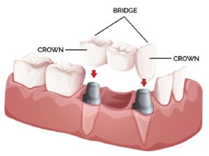 Olathe Dental Care Center Family Dentist Dental Crowns and Bridge Services blog