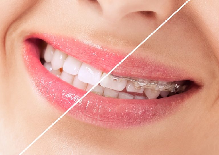 Family Dentist in Olathe Provides a Perfect Solution to